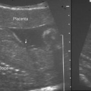 Prenatal diagnosis of bladder exstrophy (1) Prenatal diagnosis of bladder exstrophy