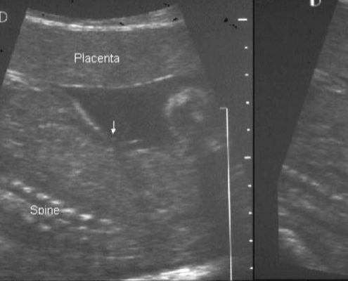 Prenatal diagnosis of bladder exstrophy