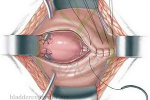 Surgery