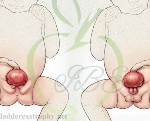 bladder exstrophy in males and females