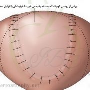 افزایش حجم مثانه به کمک برشی از روده ی کوچک. افزایش حجم مثانه به کمک برشی از روده ی کوچک.