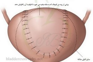 افزایش حجم مثانه به کمک برشی از روده ی کوچک.