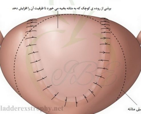 افزایش حجم مثانه به کمک برشی از روده ی کوچک.